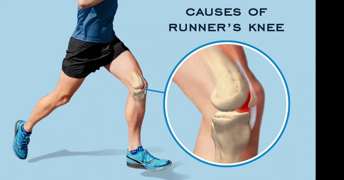 Runner's Knee: Complete Guide To Causes, Treatment & Prevention 2025