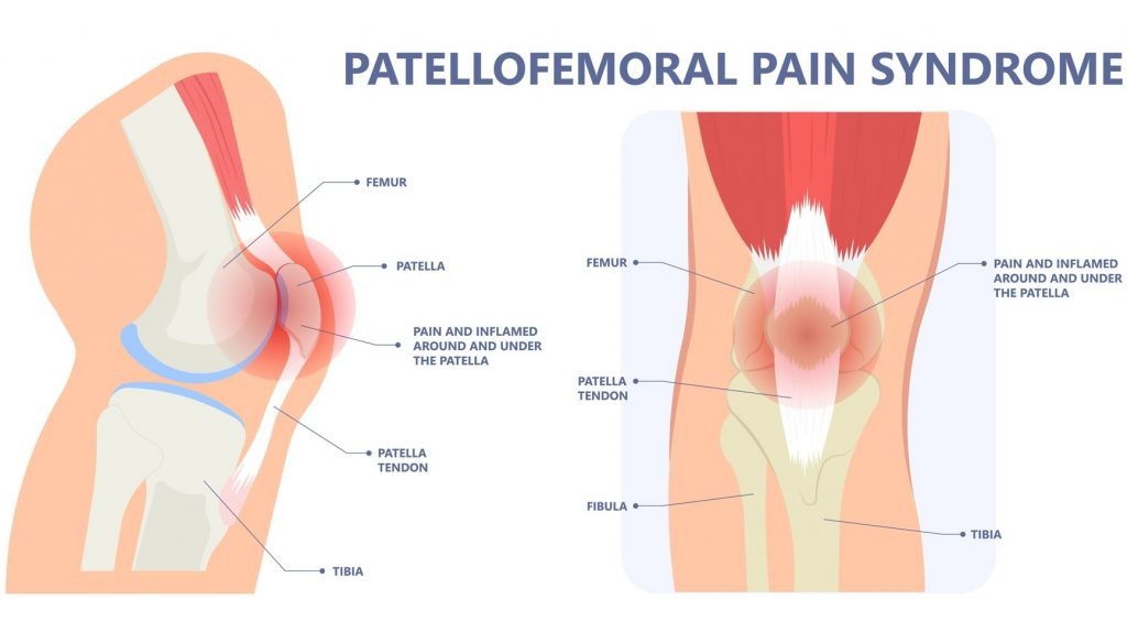 Runner's Knee: Complete Guide To Causes, Treatment & Prevention 2025