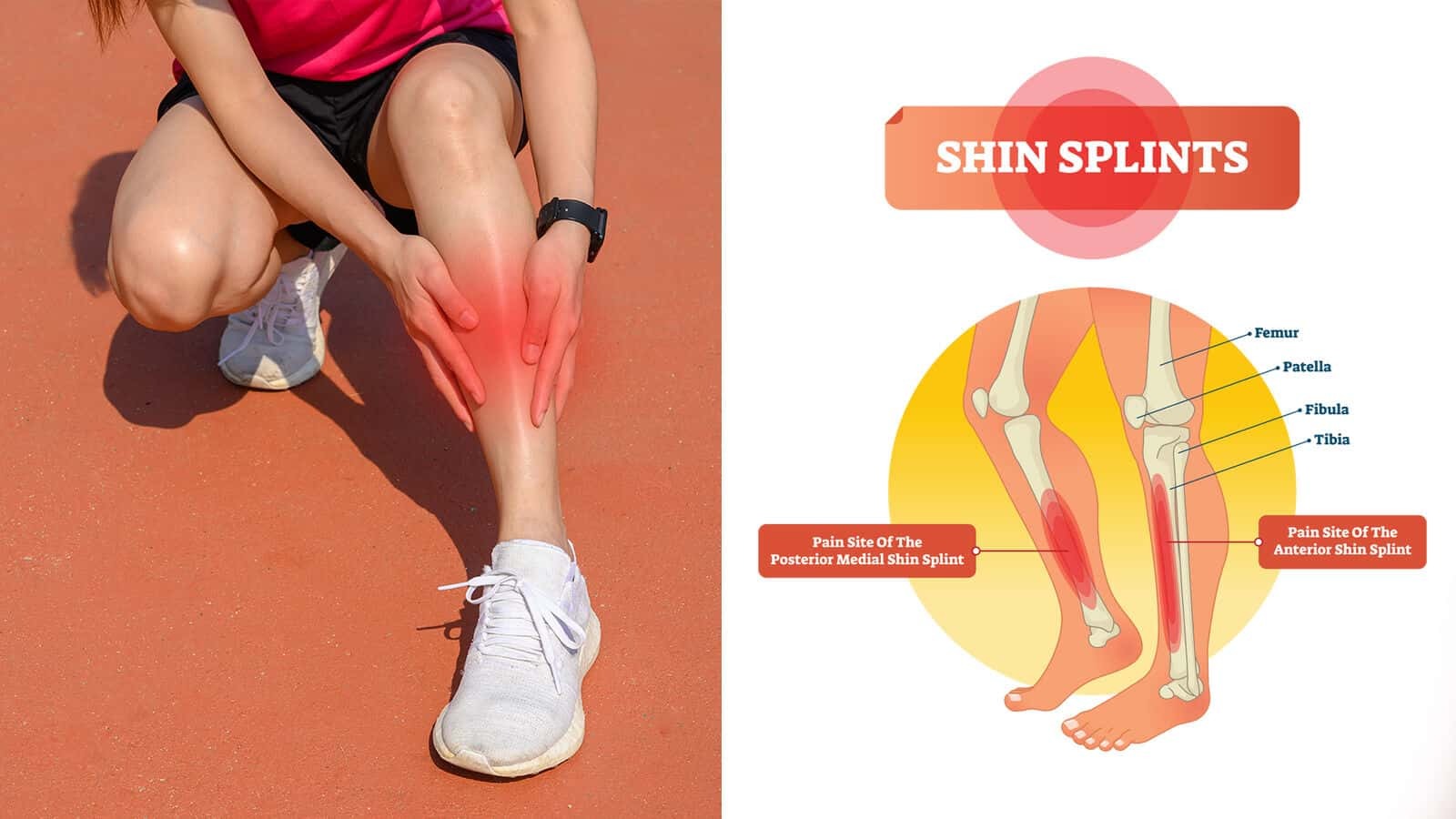 Shin Splints: Complete Guide To Prevent & Heal In 2 Weeks